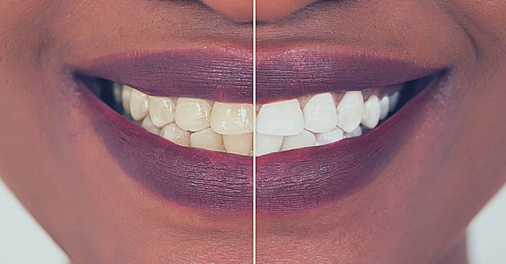 a before-and-after comparison of teeth showing noticeable whitening results from a teeth whitening treatment