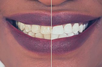 How To White Teeth: 11 Effective And Affordable Home Remedies!