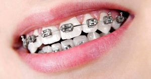 what causes overlapping front tooth and how to treat them