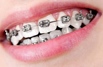 what causes overlapping front tooth and how to treat them