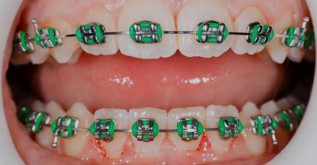 a close-up view of metal braces with green and silver brackets on upper and lower teeth for orthodontic treatment