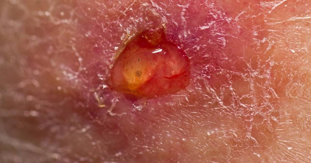 a close-up of an ulcerated canker sore on inflamed tonsil tissue with yellowish base and red surrounding mucosa