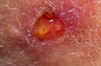 Canker Sores On Tonsil: How To Heal Ulcer On Tonsil Quickly!