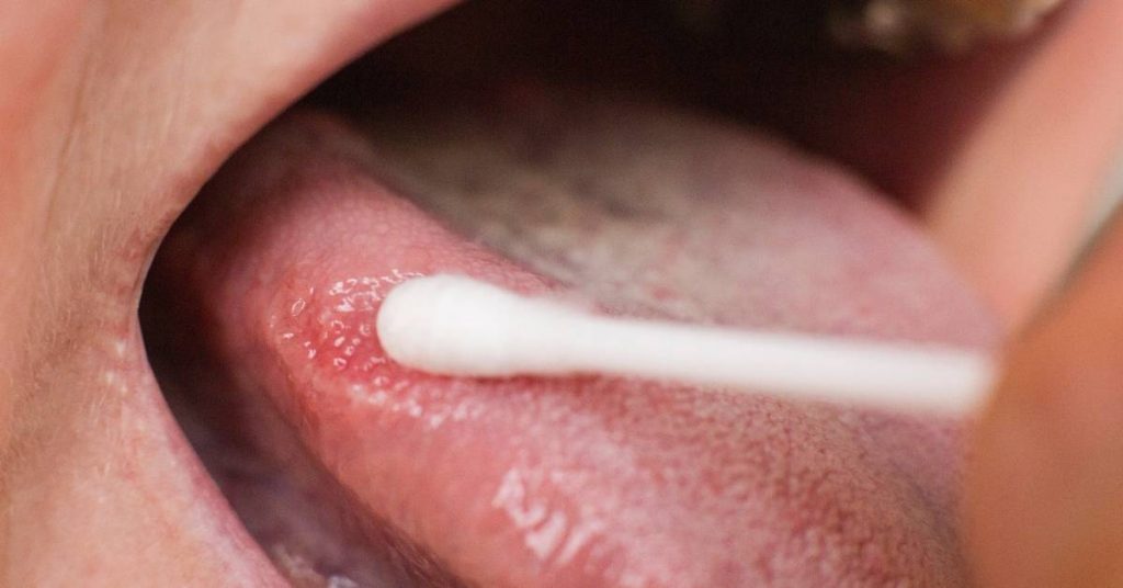 a close-up of an irritated tongue with a cotton swab highlighting a white, inflamed sore indicative of oral irritation
