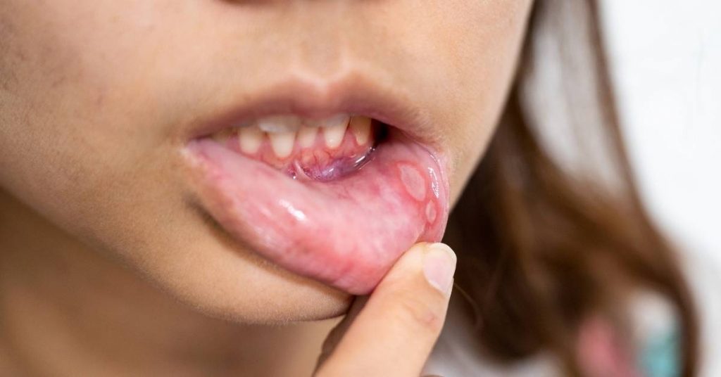 a person’s open mouth showing a painful canker sore on the inner lower lip with a finger gently pressing near it