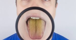 a close-up view of a discolored tongue under magnification, showing a yellowish hue indicative of potential oral health concerns.