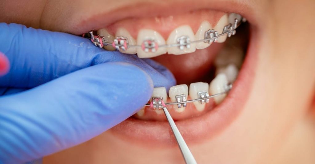 Most Popular Braces Color For Girls! Best Buying Guide