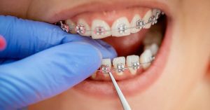 Most Popular Braces Color For Girls! Best Buying Guide