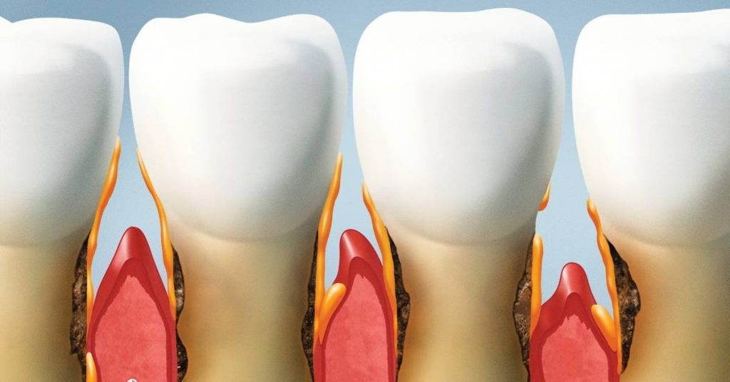 a detailed illustration of teeth showing exposed roots due to receding gums and affected gum tissue