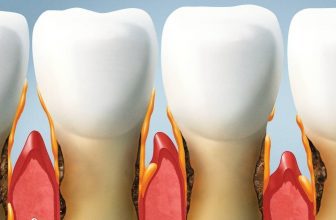 Can Receding Gums Grow Back? Best Treatments & Prevention!