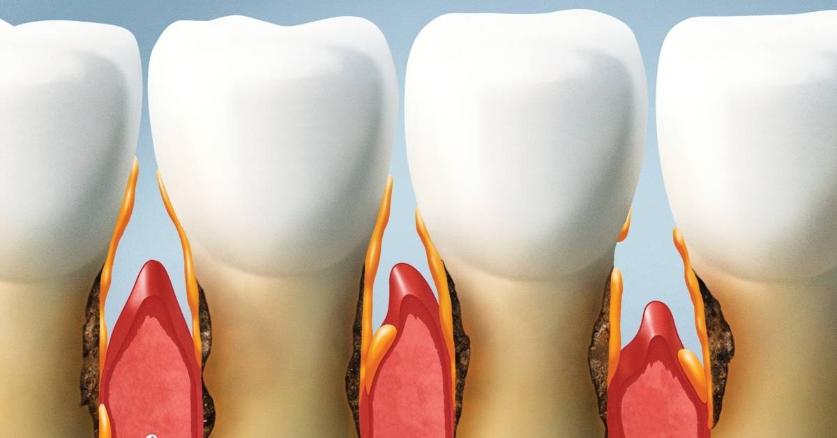Can Receding Gums Grow Back? Best Treatments & Prevention!