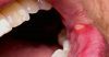 Canker Sore After Dentist Visit: Why & How To Treat Properly!