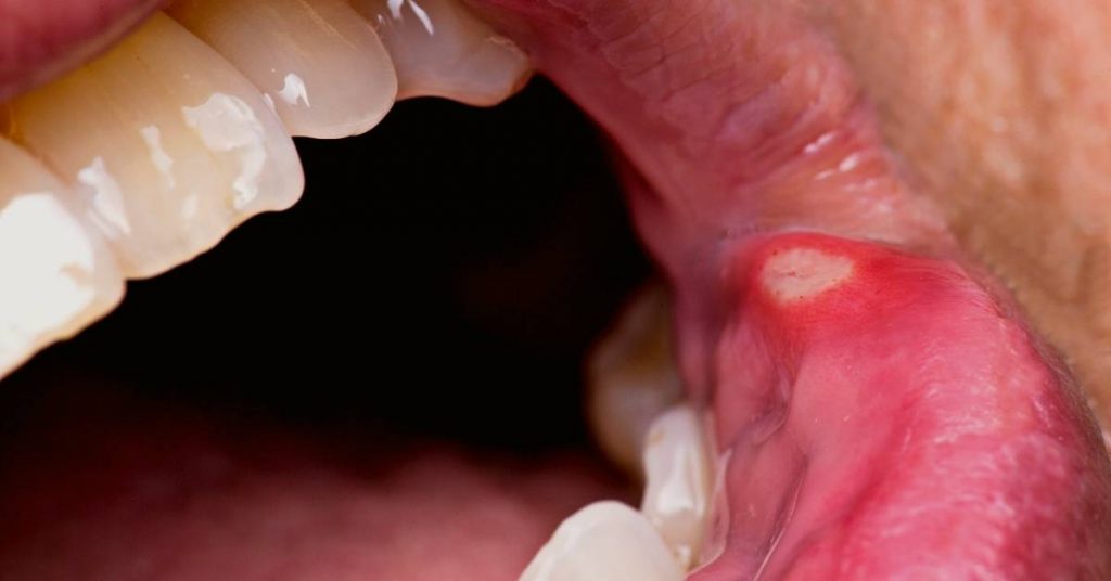 a close-up of a painful canker sore on the inner cheek near the gum line showing redness and irritation