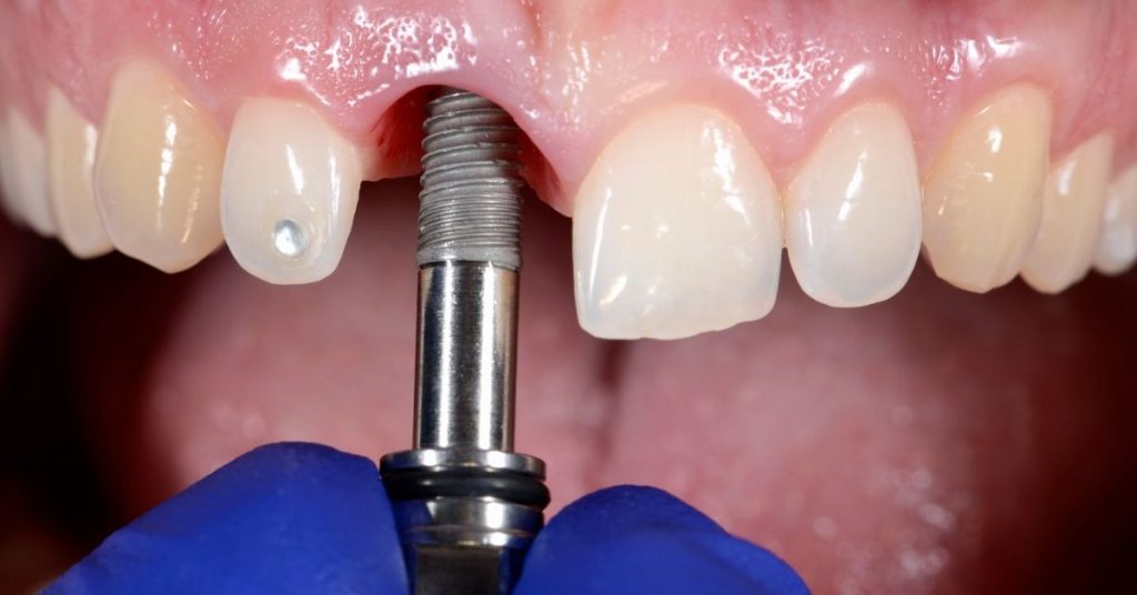 Dental Implants And Smoking: Ultimate Guide