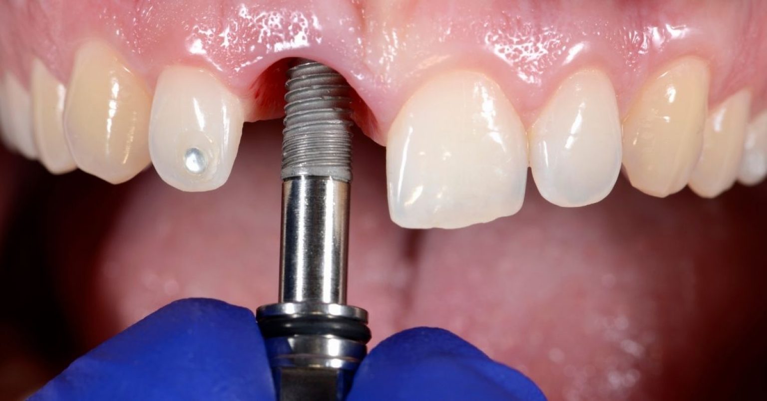 Dental Implants And Smoking Ultimate Guide 2024
