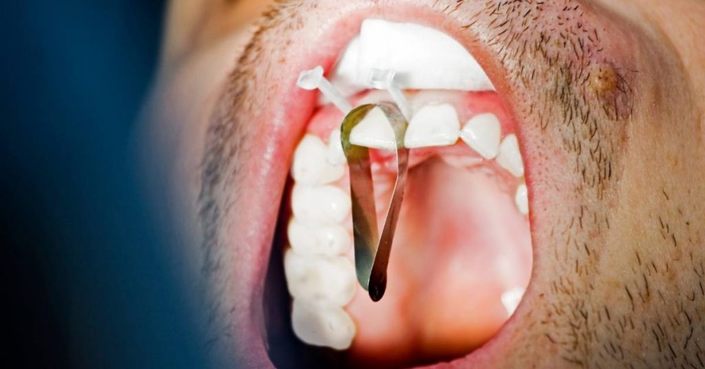 a close-up of a dental crown procedure on an upper front tooth with a metal post and temporary crown in place