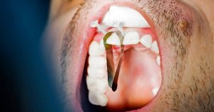 Can You Get A Crown on a Front Tooth? Ultimate Guide