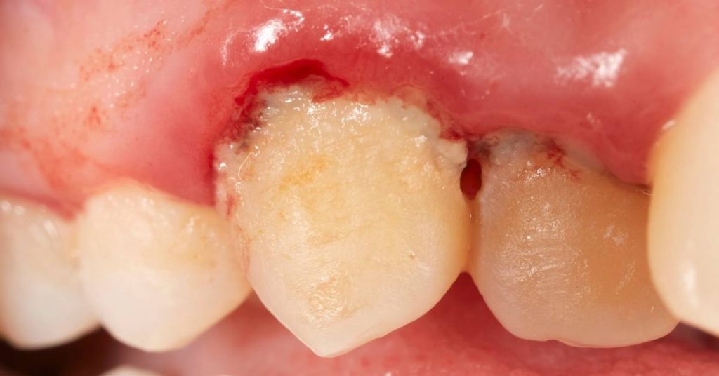 a close-up of exposed gum tissue and a tooth undergoing dental irrigation after deep teeth cleaning, showing early healing