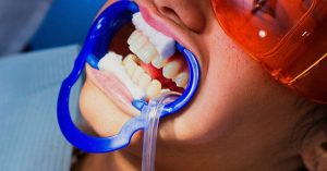 a patient undergoing laser gum treatment with a protective mouthpiece and safety goggles for periodontal therapy