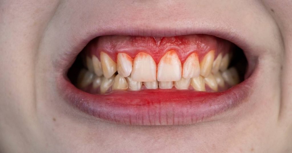 Osseous Surgery: Is It Needed? Recovery & Cost!