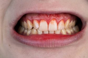 Osseous Surgery: Is It Needed? Recovery & Cost!