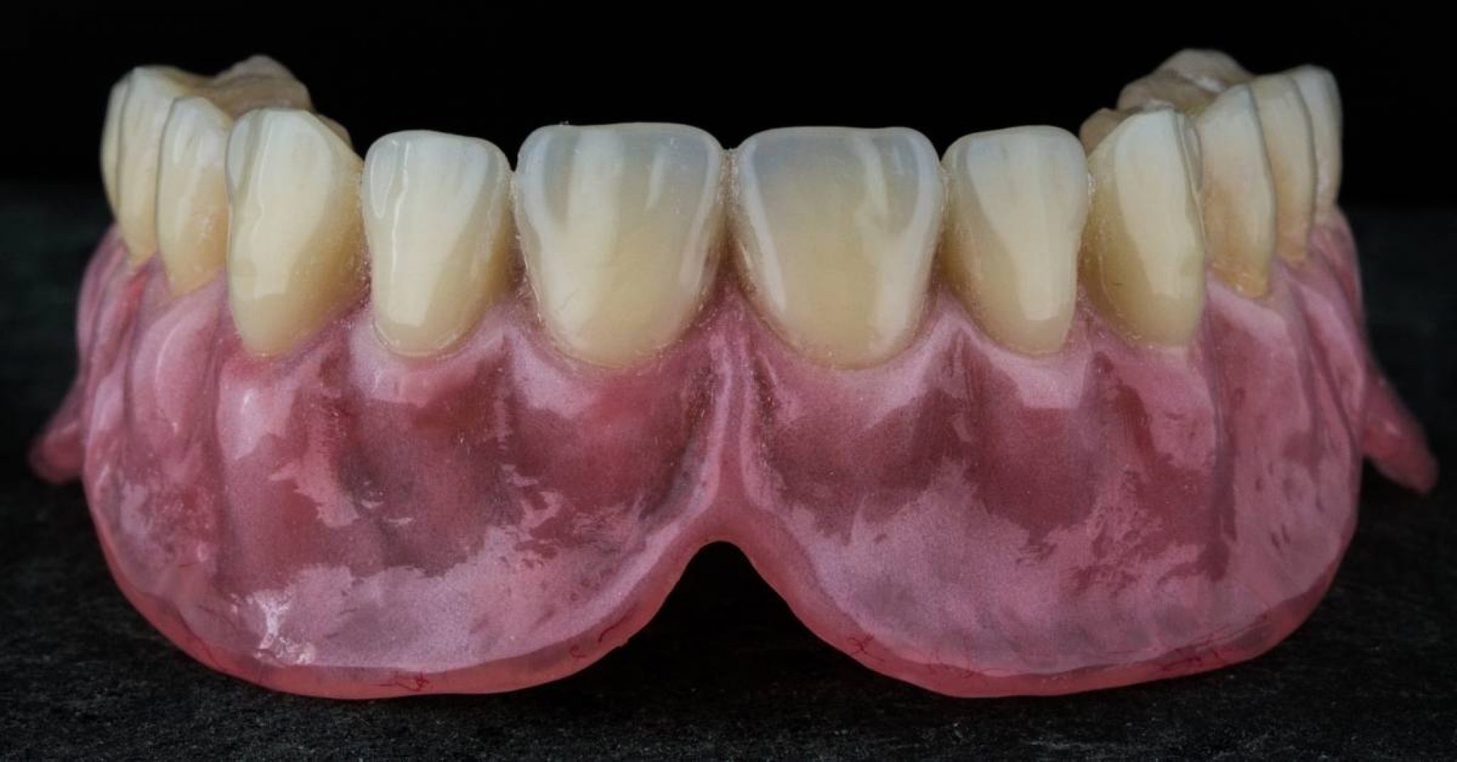 What Do Teeth Look Like Under Veneers? Ultimate Guide 2024