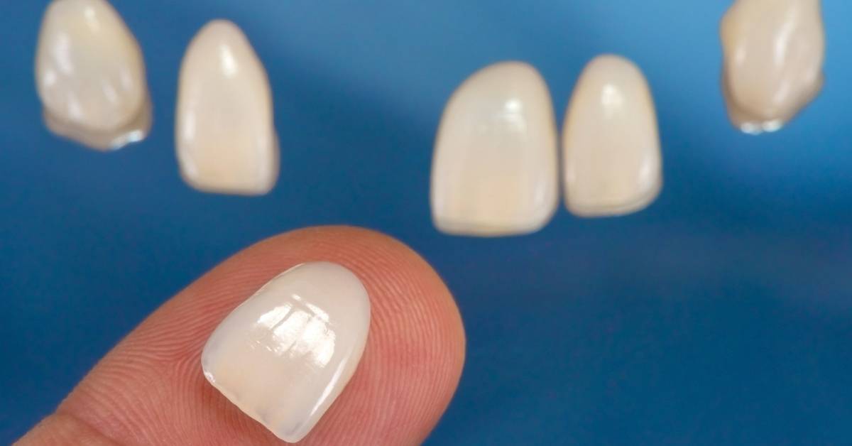What Do Teeth Look Like Under Veneers? Ultimate Guide 2024