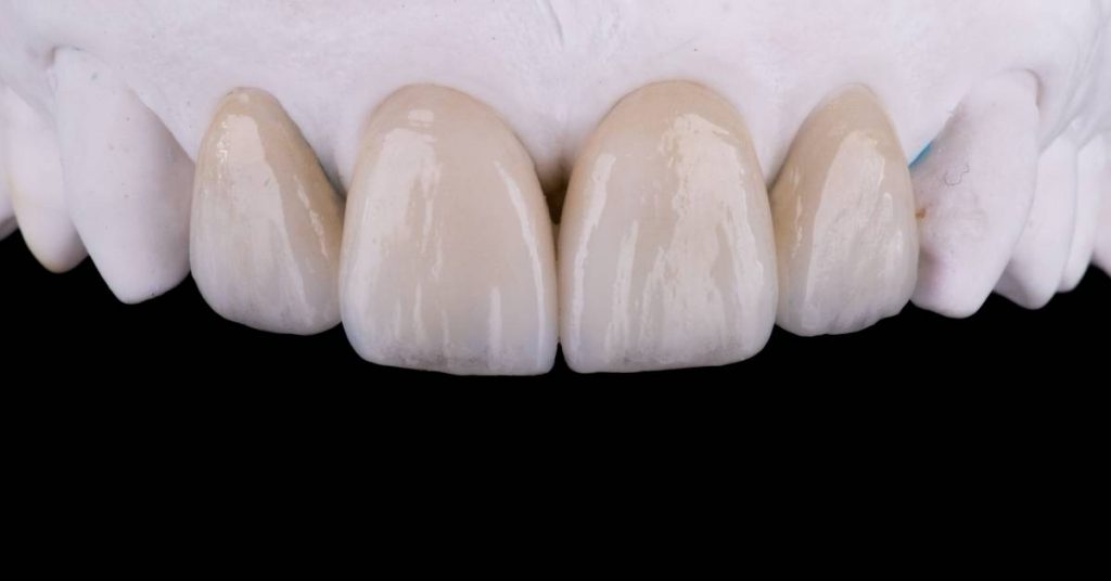 a close-up of four porcelain veneers on front teeth showing signs of wear from teeth grinding