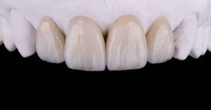 Can You Get Veneers If You Grind Your Teeth? 10 Facts You Need To Know!