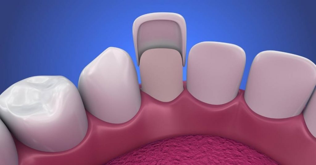 a close-up 3D rendering of thick dental veneers placed on front teeth, showing their bulky appearance over natural teeth.