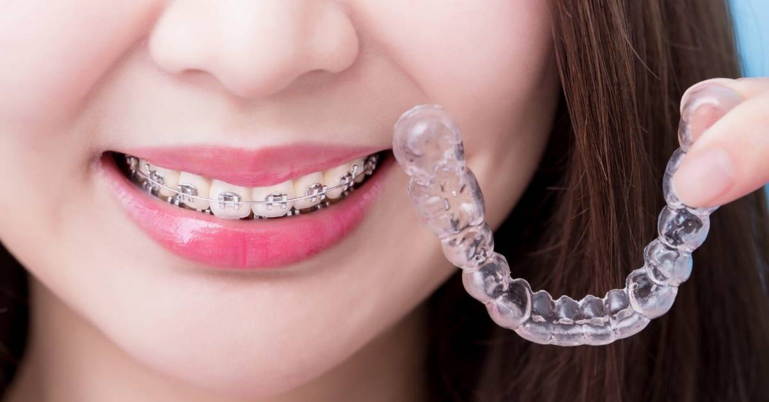 What's Shortest Time Period For Braces? How To Shorten It!