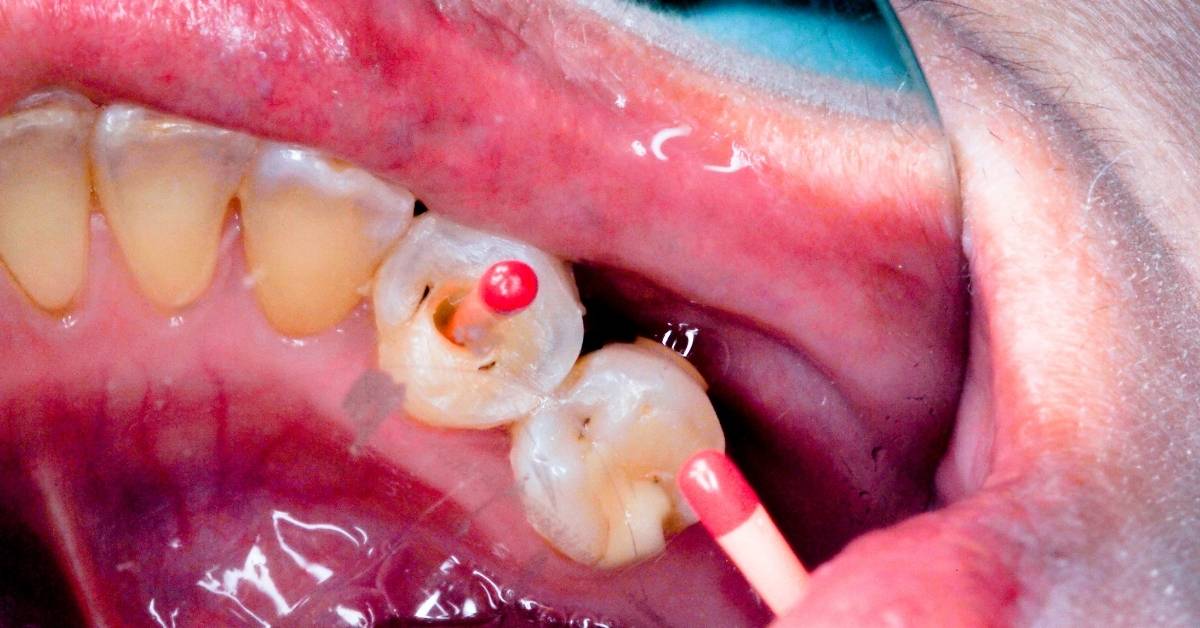 Are Root Canals Bad For You? Ultimate Guide 2024