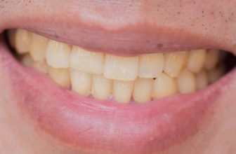 13 Causes Of Sudden Brown Stains Between Teeth & How To Treat Them!
