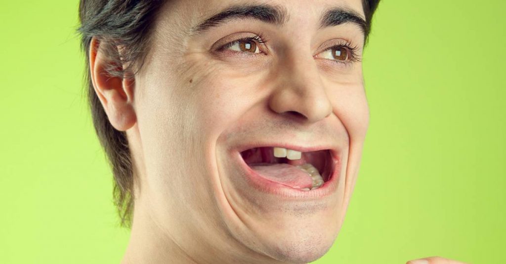 a person with visibly loose lower teeth, smiling widely to show dental gaps possibly related to oral health concerns