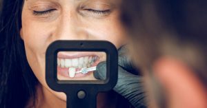 Plantation Smiles: For Beautiful White & Healthy Teeth! 15 Teeth Veneers Pros And Cons Of This Dental Treatment! Are they right fit for your needs?