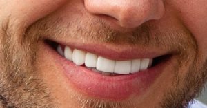 a close-up of a person’s lower front teeth with visible dental work, showing a gum line and partial upper lip.