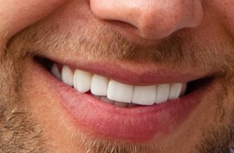 What happened to Kevin Costner's teeth