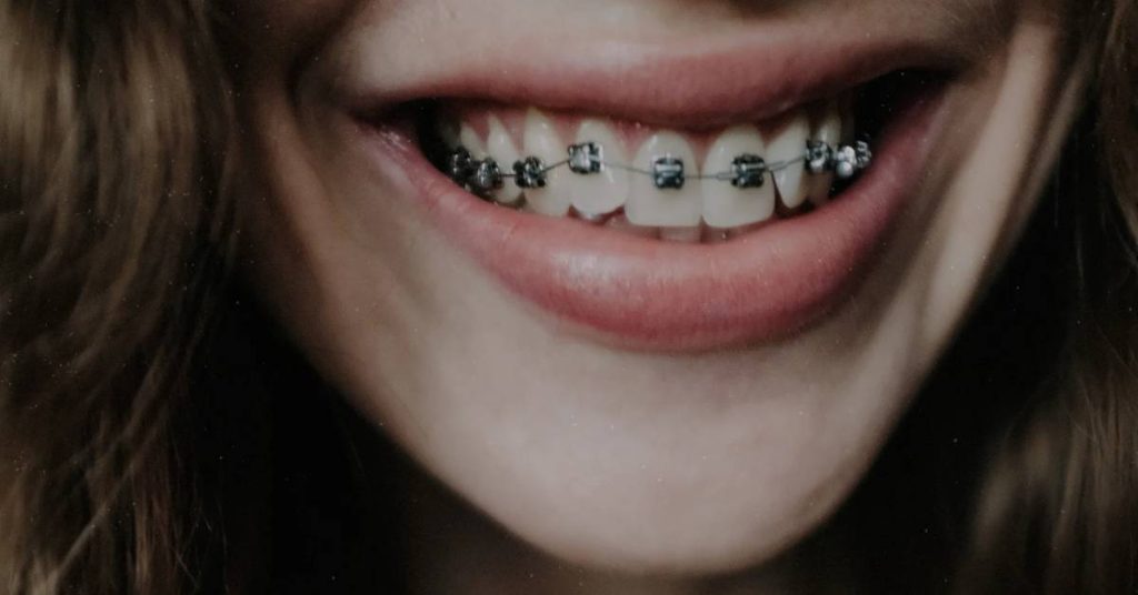 a smiling person wearing metal braces on their teeth