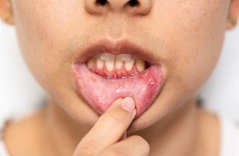 What Does a Canker Sore Look Like? Identifying Symptoms and Treatment Options