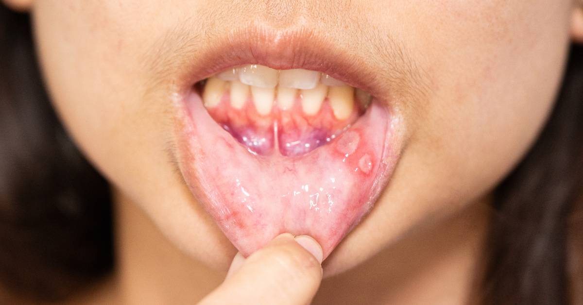 7 Stages of Canker Sores: A Comprehensive Treatment Guide