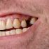 Brock Lesnar’s Dental Issues: What’s Wrong with His Teeth?