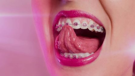 20 Cute Braces Colors & Color Combinations!