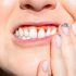 Tooth Splinting Can Help Save Loose Teeth | Ultimate Guide