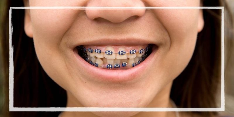 Power Chain Braces 13 How Long Into Braces Do You Get Power Chains?