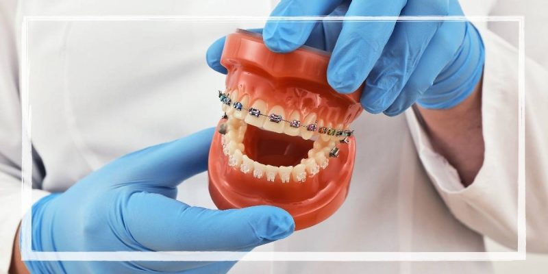 Power Chain Braces 9 How To Fix A Power Chain On Braces | Ultimate Guide