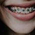 Can You Eat Pop Rocks with Braces? Tips and Precautions