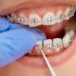 What’s Shortest Time Period For Braces? How To Shorten The Treatment TIme!
