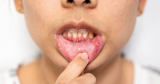 What Does a Canker Sore Look Like? Identifying Symptoms and Treatment Options