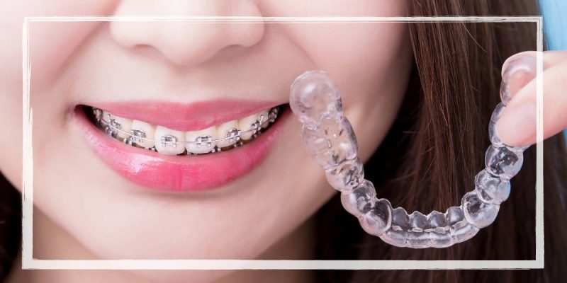 Power Chain Braces 11 Why Do You Need Power Chains On Braces | Dentist Explains