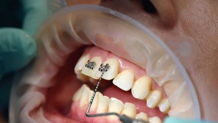 20 Reasons To Choose Black Braces Color | Ultimate Style Guide